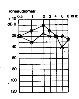 Audiogram over dagplejer i 26 år med tinnitus uden arbejdsbetinget hørenedsættelse