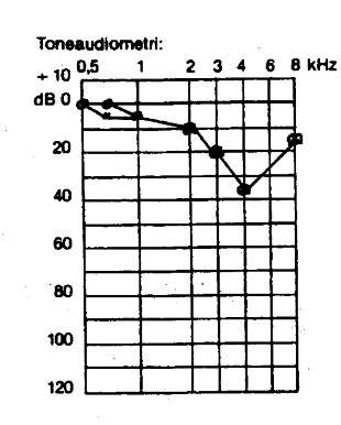 Audiogram over maskinsmed i 5 år med støjbetinget hørenedsættelse