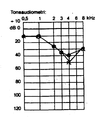 Audiogram over driftstekniker i 26 år med hørenedsættelse, ikke sammenhængende med støj