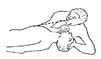 Grafisk illustration af hvordan man blæser indtil der ses at den forulykkedes brystkasse hæve sig.