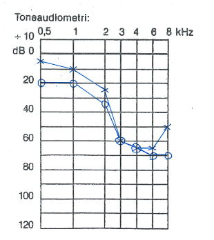 Audiogram over typograf i 28 år med konkurrerende høresygdom og beskeden hørenedsættelse med stærkt generende tinnitus