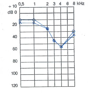 Audiogram over maskinbarbejder i mere end 25 år med støjbetinget hørenedsættelse