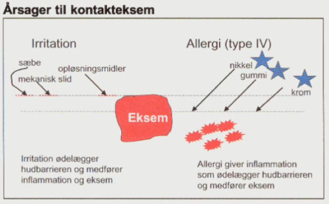Illustration af årsager til kontakteksem ved irritation (sæbe, mekanisk slid, opløsningsmidler) og ved Type IV-allergi (nikkel, gummi, krom)