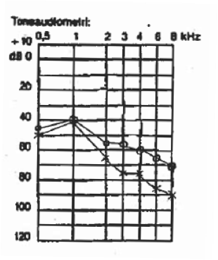 Audiogram over klejnsmed i 20 år med overvejende andre årsager end hørenedsættelse
