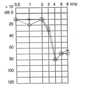 Eksempel på audiogram, som ikke viser en støjskade trods dip ved 4000 Hz