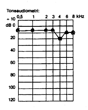 Audiogram over slagteriarbejder i 2 1/2 år med hørenedsættelse - for kort støjudsættelse
