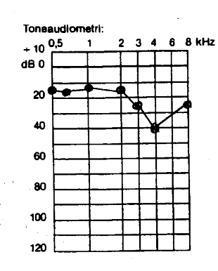 Audiogram over pladsesmed i 20 år med beskeden støjbetinget hørenedsættelse med kraftigt generende tinnitus
